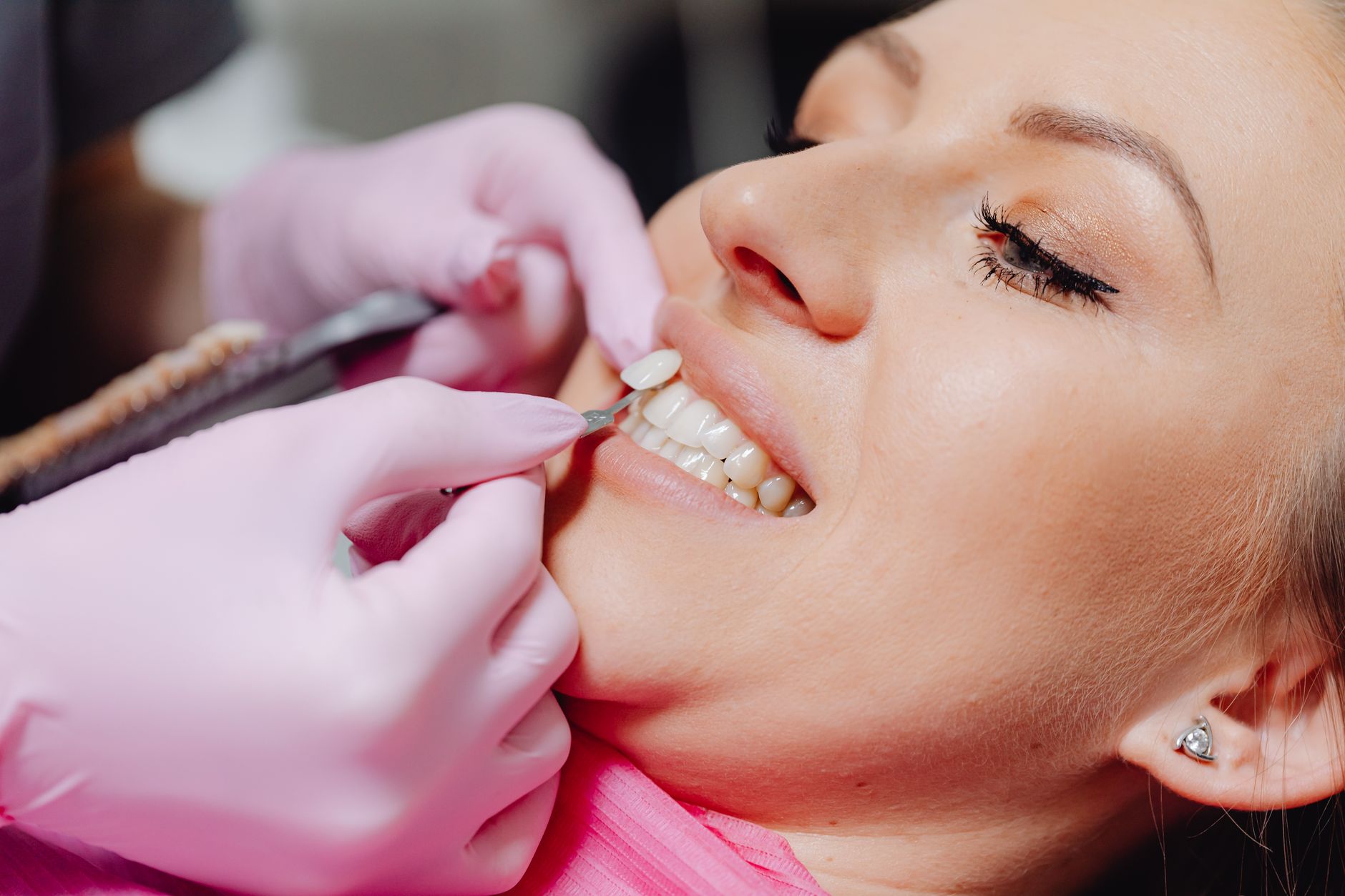 Close-up of a patient receiving porcelain veneers placement at a dental office.