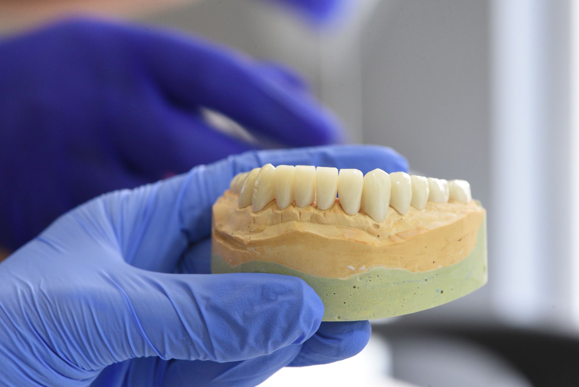 Close-up of a custom 3D-printed titanium implant used in limb-salvage surgery.