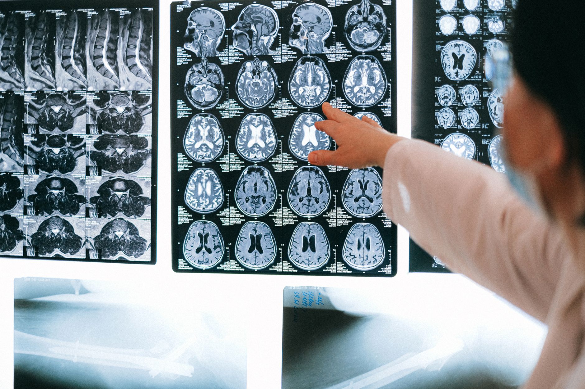 A surgeon points at abdominal CT scans while planning a complex hernia repair procedure.
