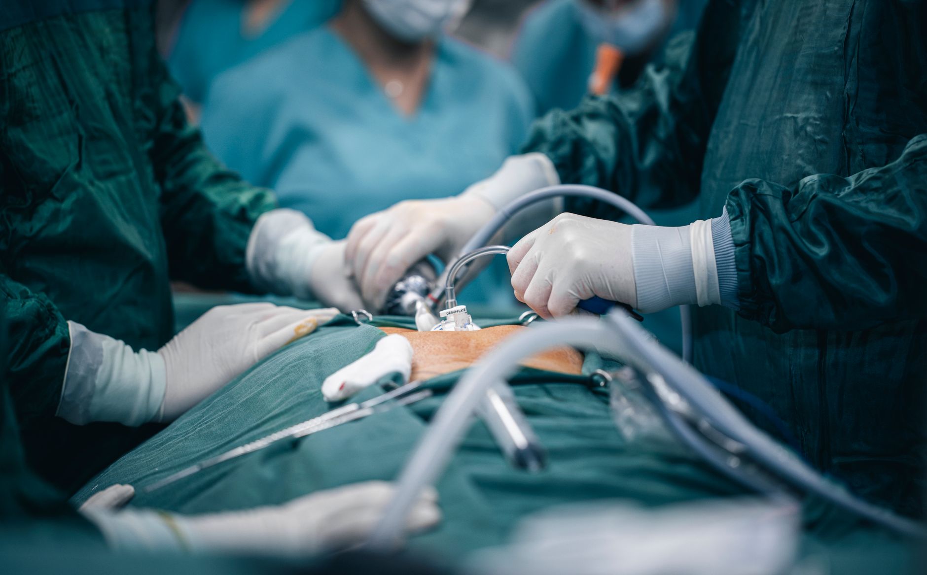 Surgeons performing laparoscopic bariatric surgery in Antalya's modern operating room.
