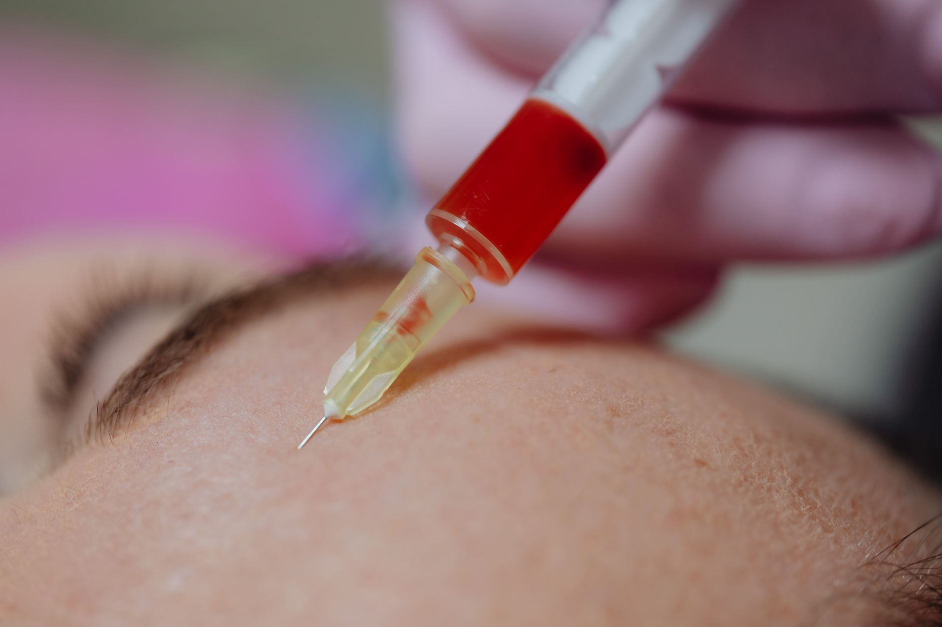 Close-up of PRP injection into scalp during hair restoration treatment.