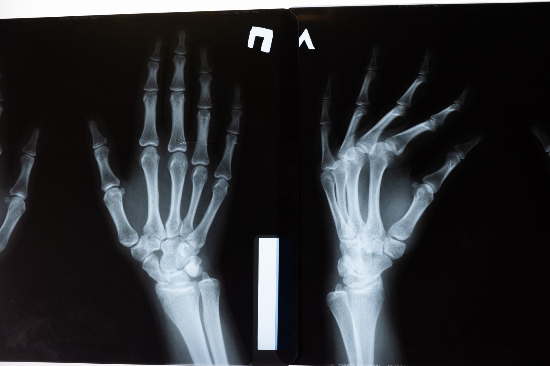 Hand X-rays showing bone structure, used for microsurgery discussion.