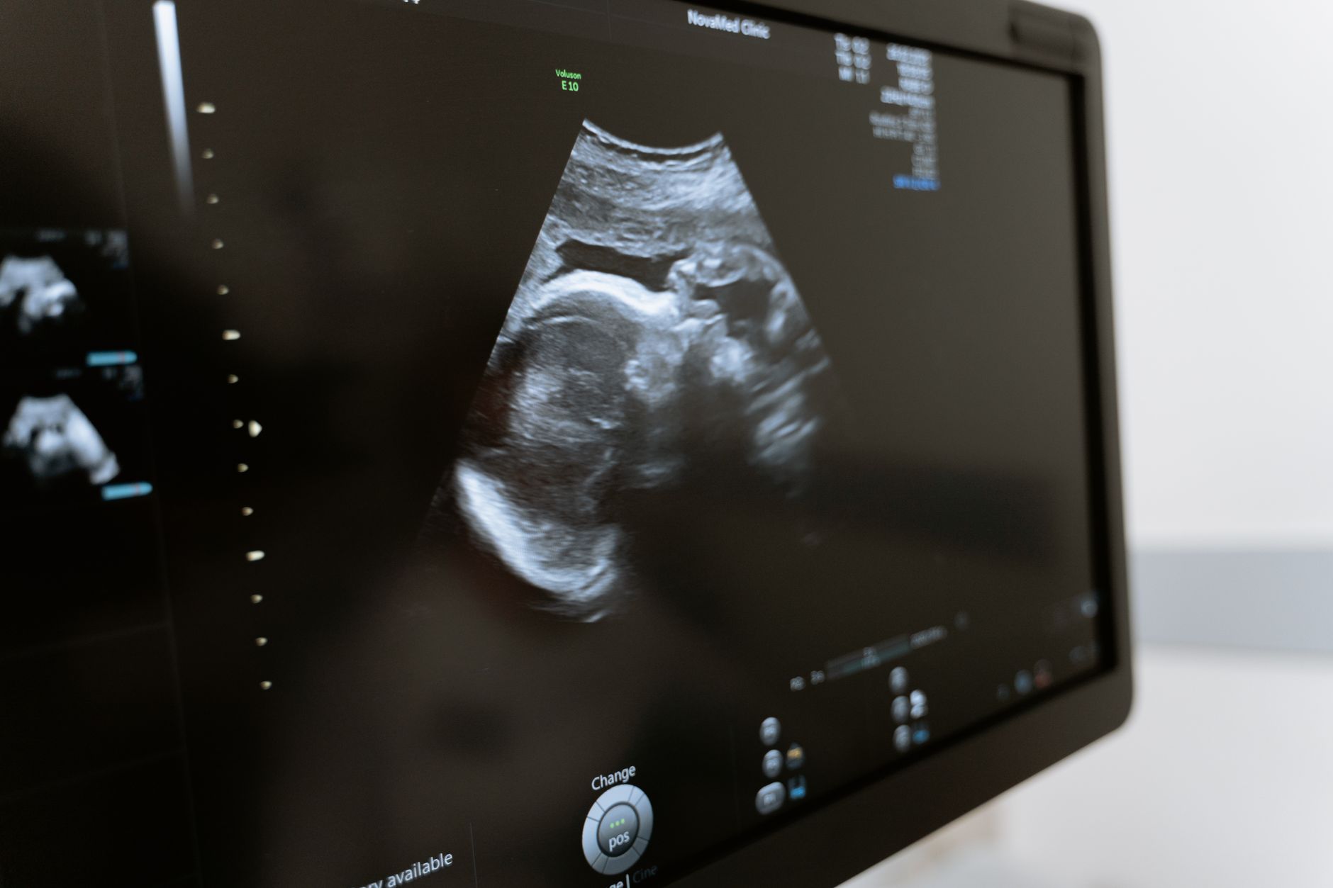 Ultrasound image showing detailed monitoring of ovarian stimulation process.
