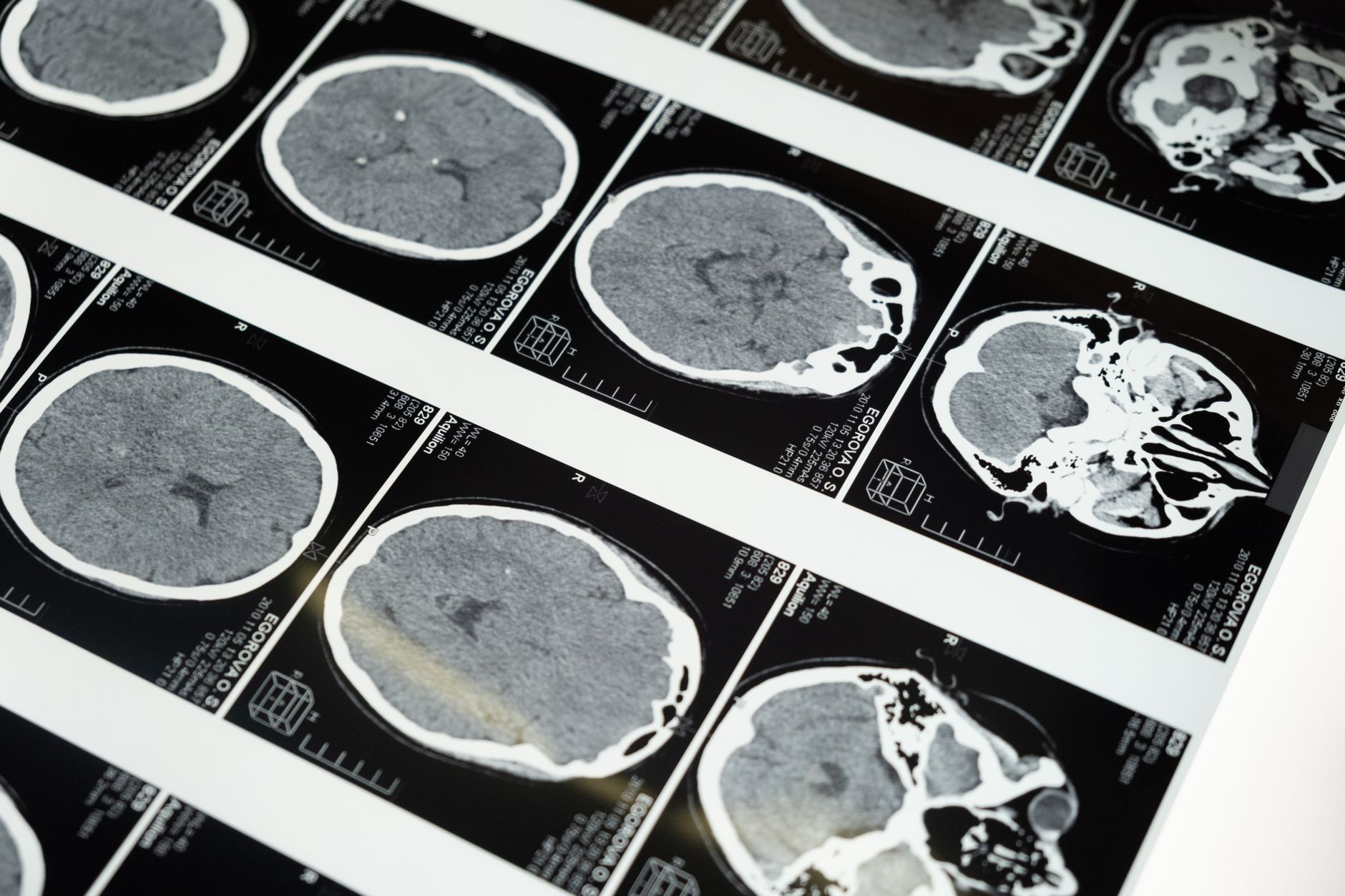 Close-up of CT scan images displayed for analysis in a Turkish hospital.