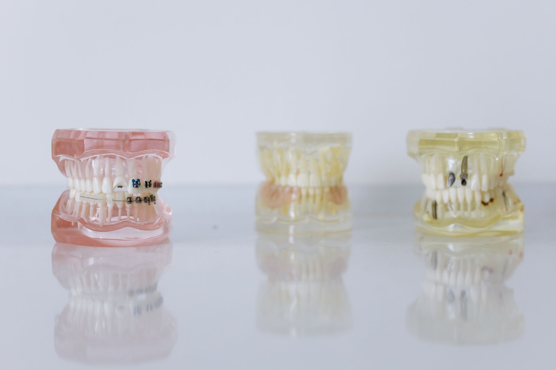 Close-up of three dental models showcasing braces and orthodontic preparation.