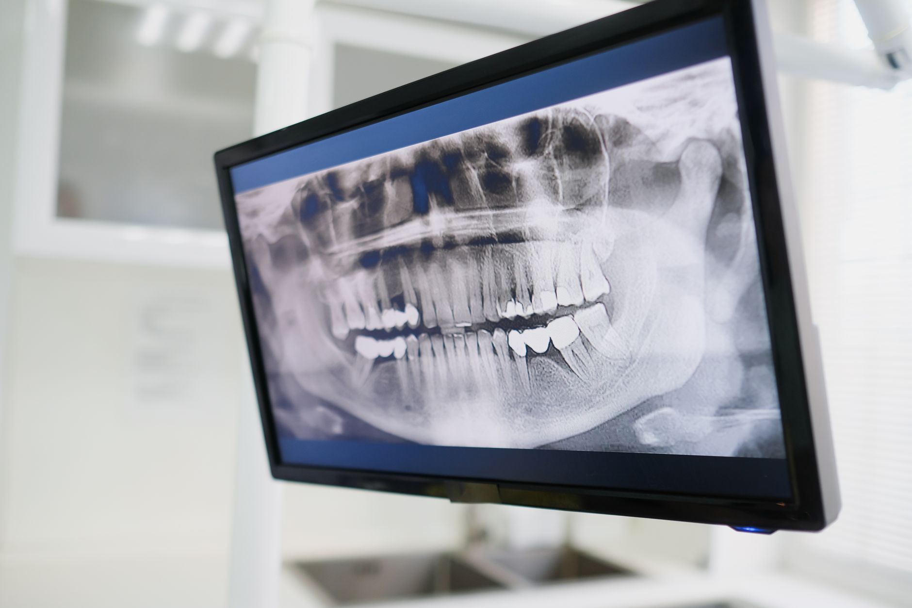 Screen showing a 3D simulation of a nose for rhinoplasty planning.