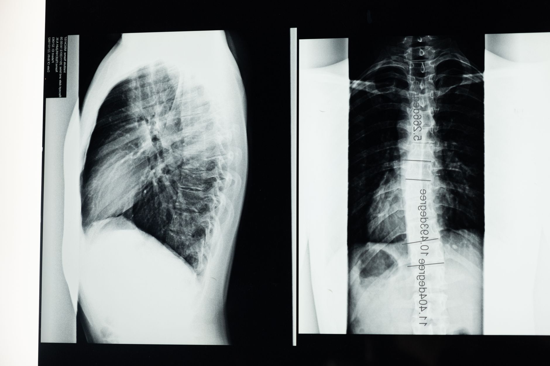 Doctors discussing treatment plan while reviewing spinal X-rays for pre-operative assessment.