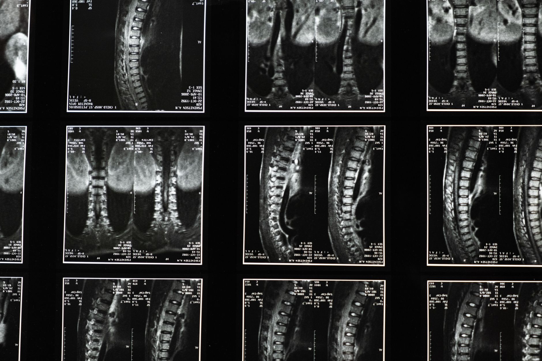 MRI scan images showing detailed views of a patient's spine for diagnosis.