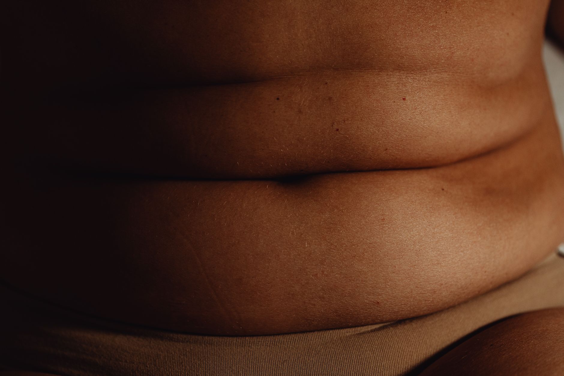 Close-up view of skin folds demonstrating abdominoplasty surgery technique.