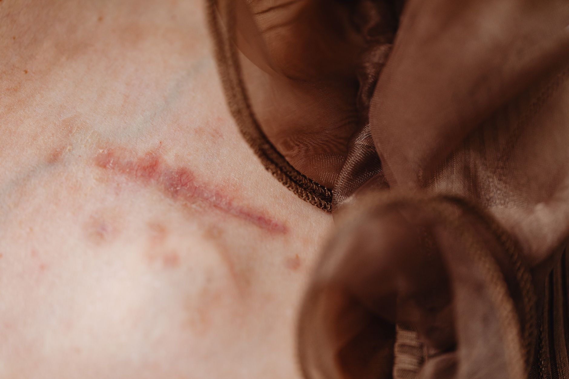 Close-up of skin showing surgical scar with compression garment detail after tummy tuck.