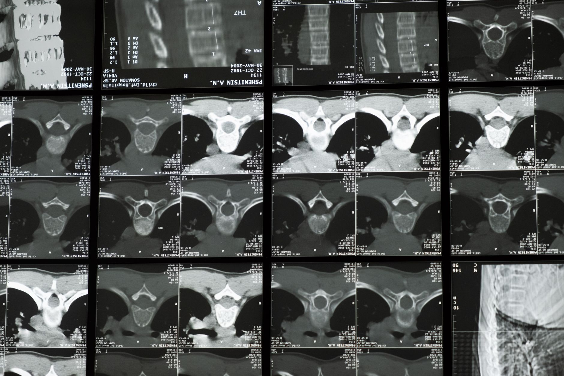 Medical images showing detailed CT scans of the spine for diagnosis.
