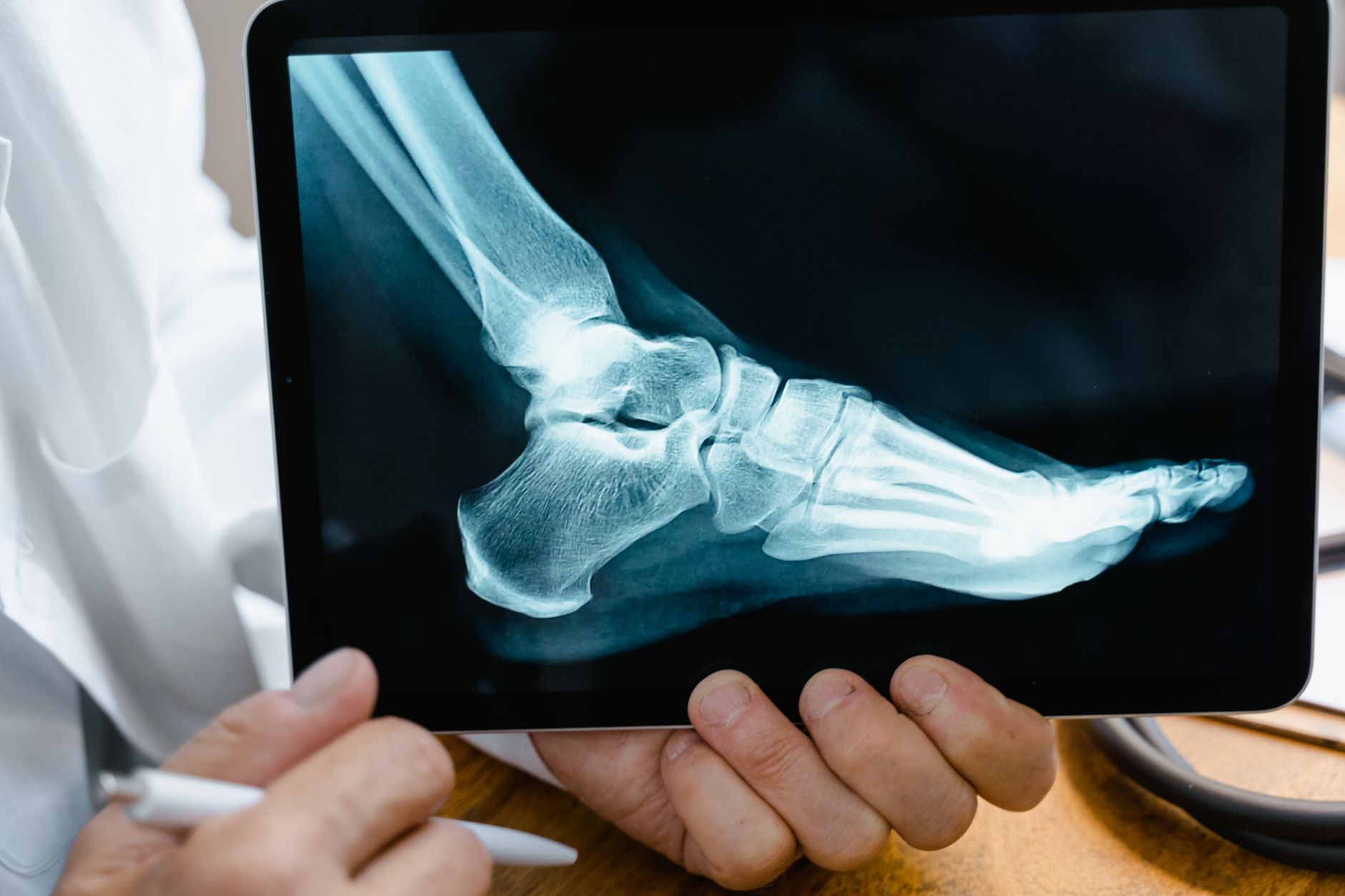 Close-up of a foot X-ray highlighting a hallux valgus bunion.