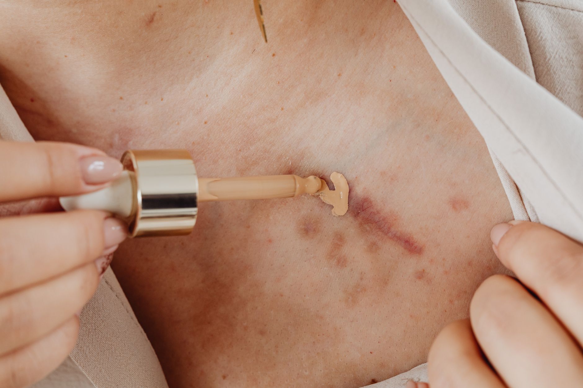 Close-up of a person applying foundation on skin with scars, showing details of the skin texture and the product.