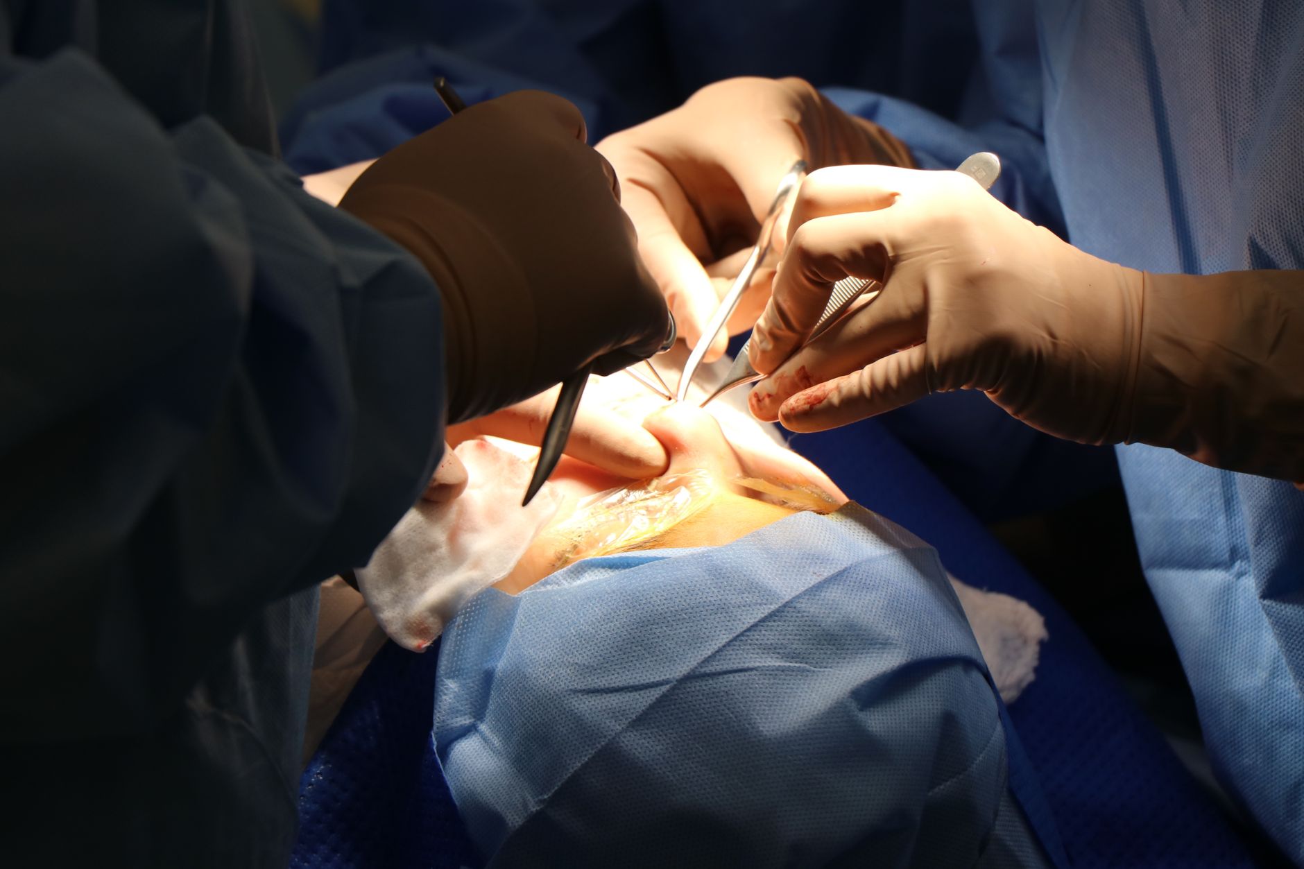 Surgeons performing a delicate hand and nerve reconstruction surgery under a microscope.