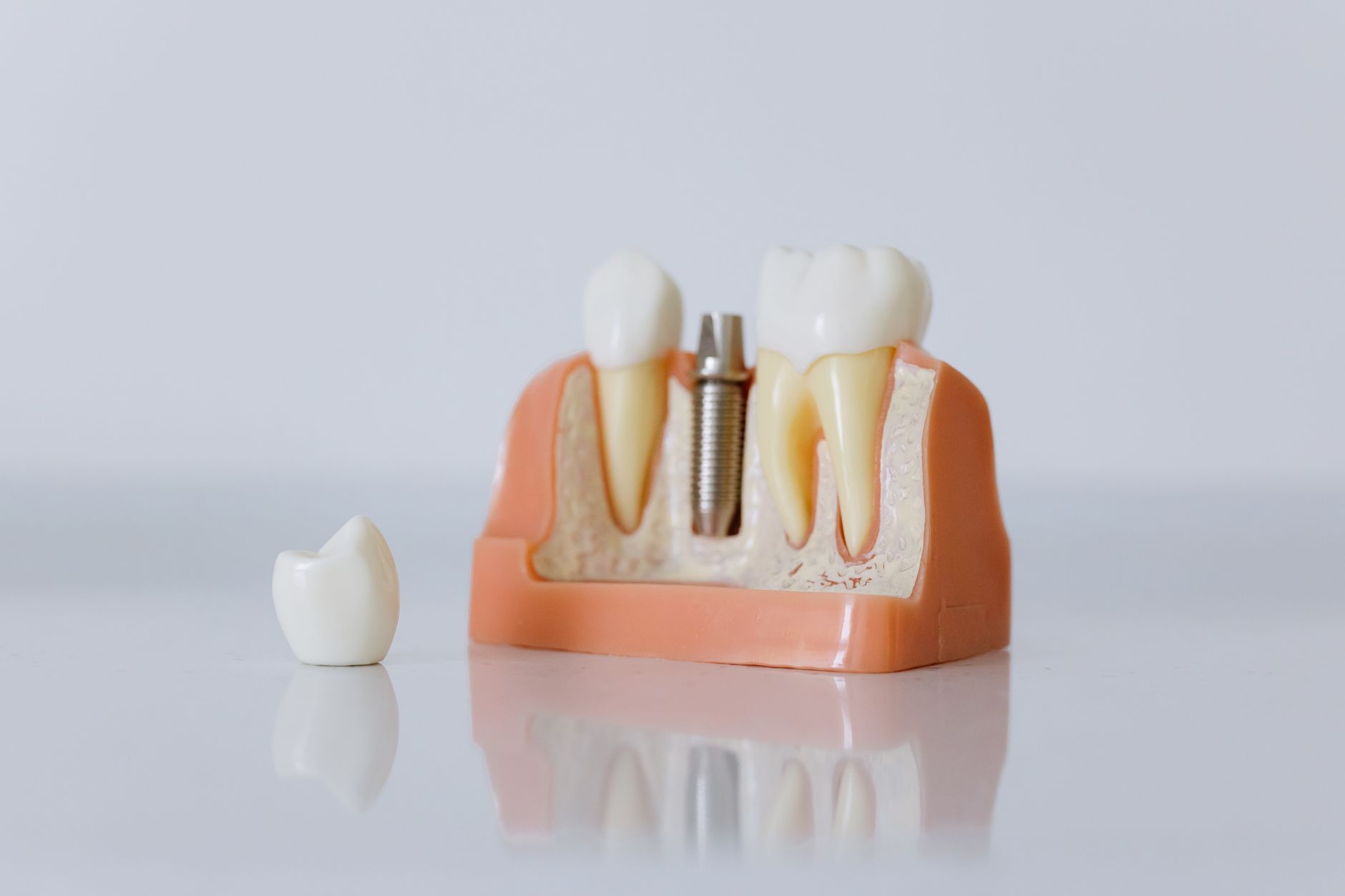 Detailed model of a dental implant procedure with teeth and an implant.