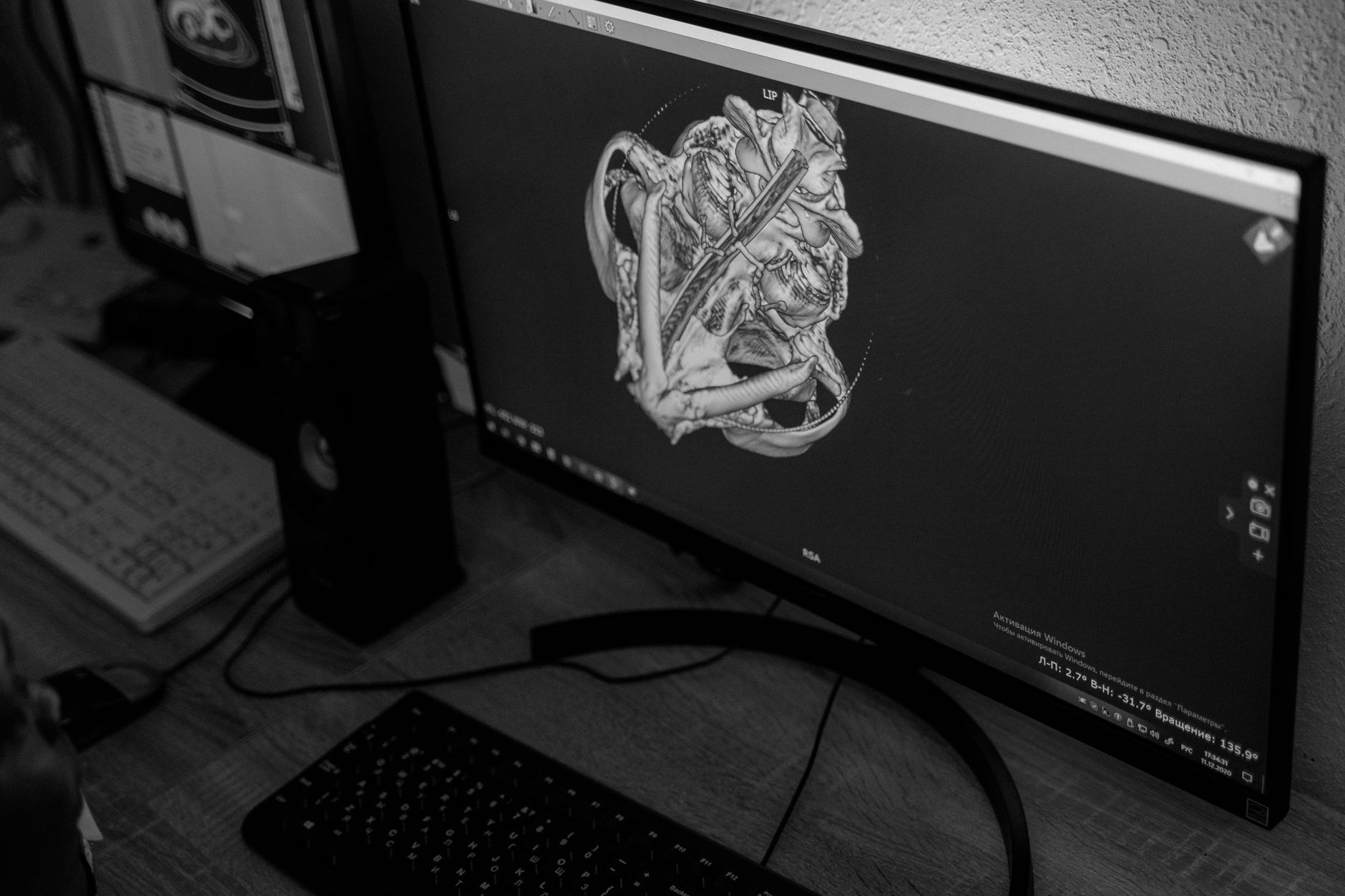 Close-up of a computer monitor displaying a 3D skull model for surgical planning in a clinical setting.