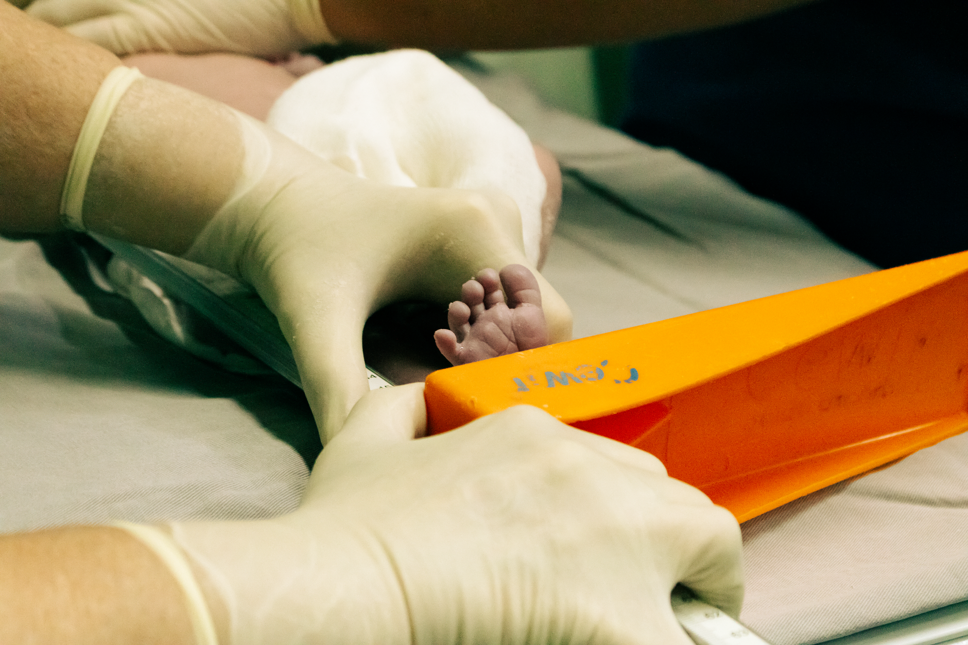 A pediatric orthopaedic specialist applies a cast to an infant's foot.