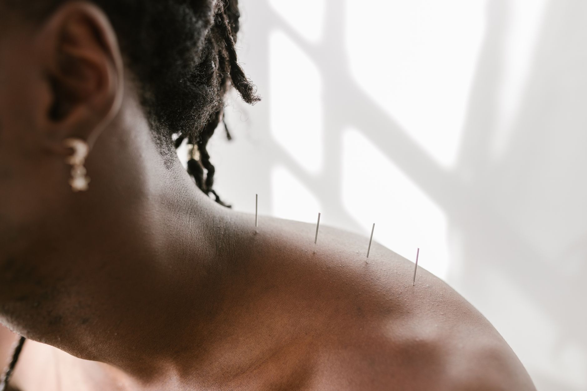 Licensed acupuncturist performing acupuncture on a patient's shoulder.