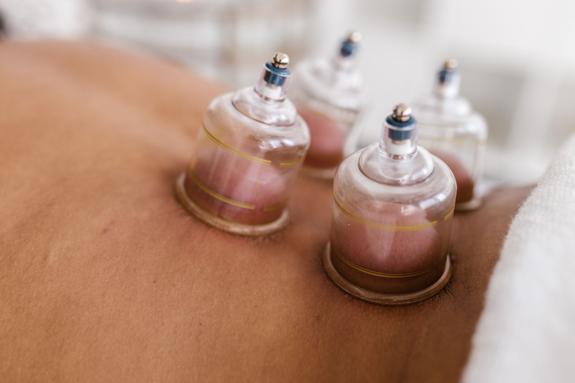 Cupping therapy cups applied on a patient's back in a clinic setting.