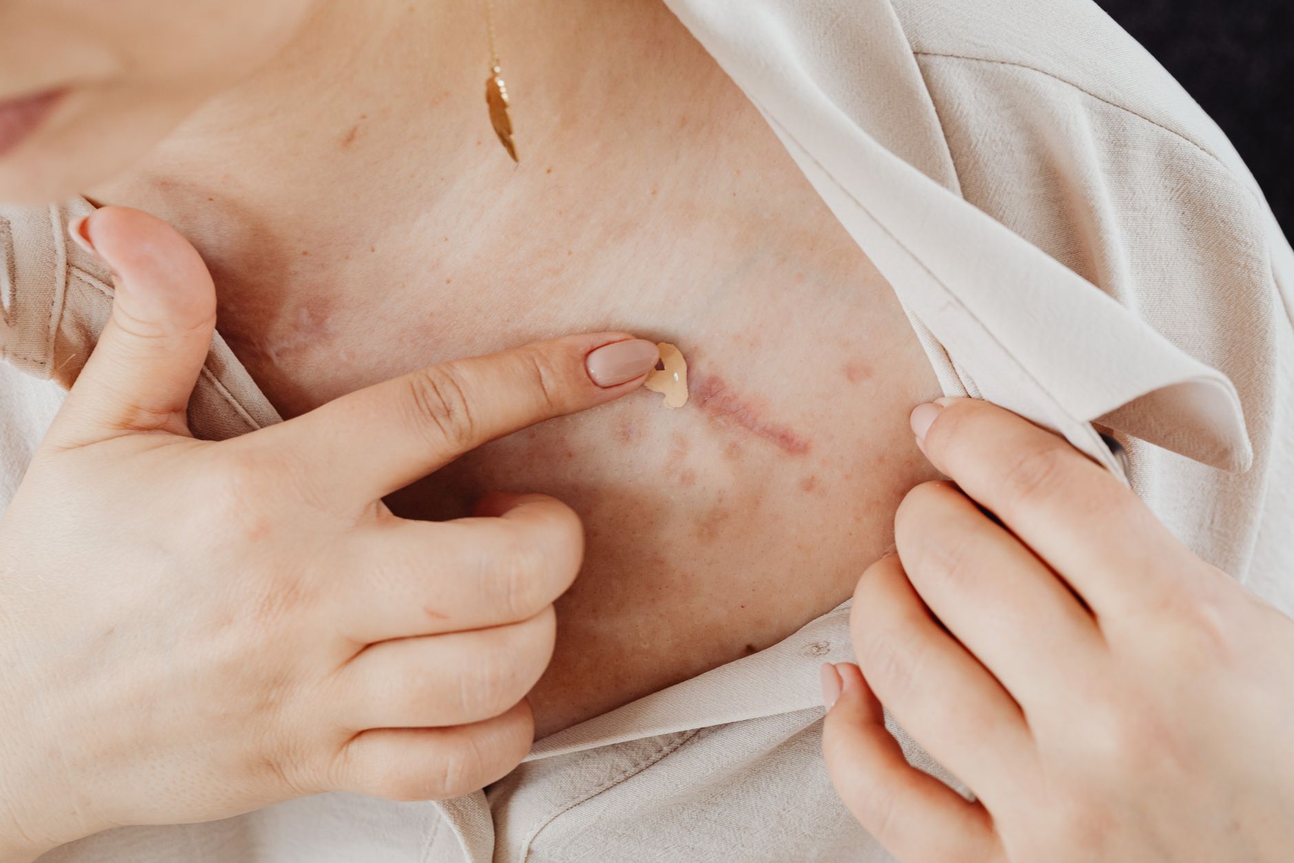 A person applies a silicone sheet to a healing scar on their chest.